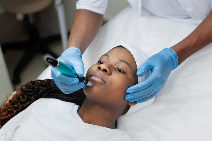 You are currently viewing Microneedling: Unlocking Your Skin’s Natural Radiance